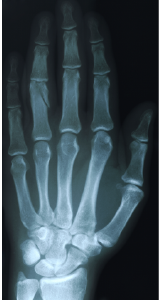 X-ray image of a hand