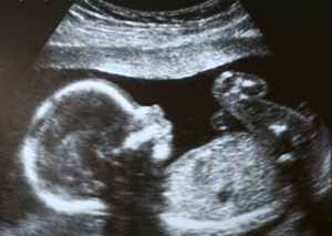 Ultrasound of a fetus