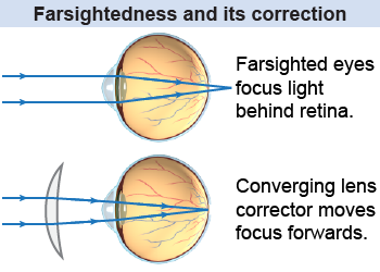 Farsighted eyes focus images behind the retina and are corrected with converging lenses