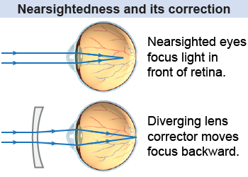 Nearsighted eyes focus images in front of the retina and are corrected with diverging lenses