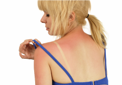 Woman sunburned by ultraviolet radiation from the Sun