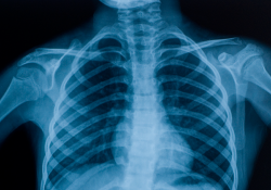 Chest x-ray shows bones and dense organs